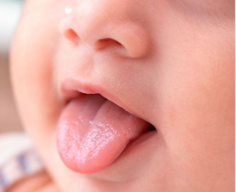 Tongue Tie
