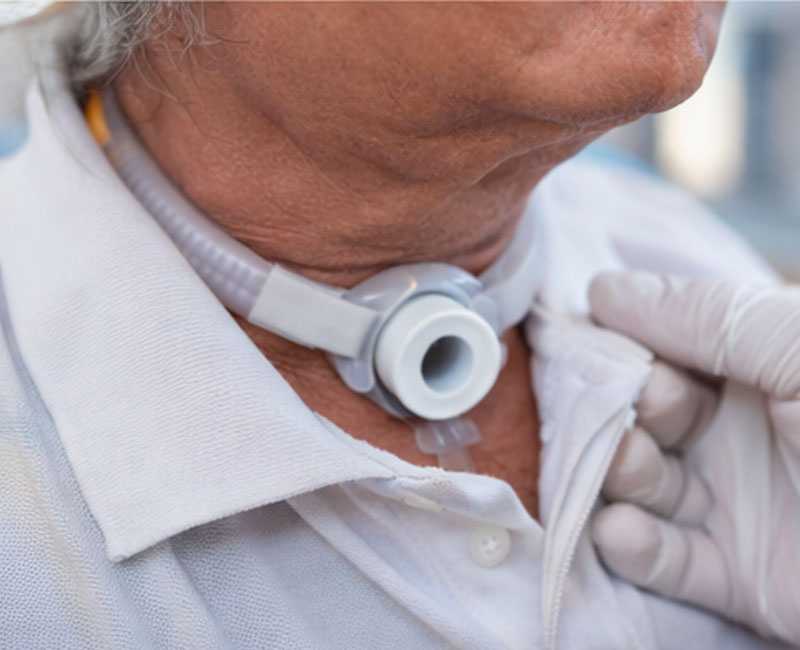 Tracheostomy Care